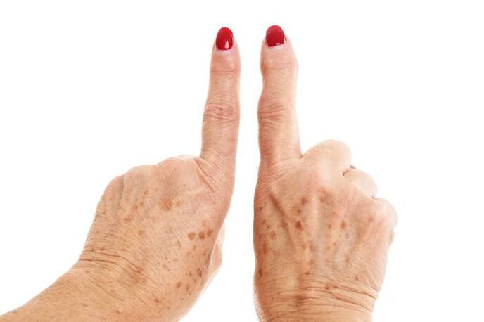 деформуючий артроз на пальцях рук