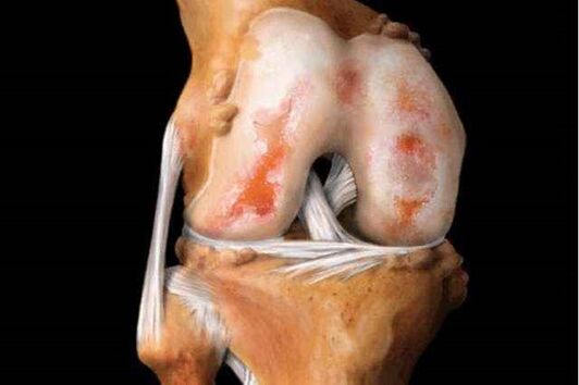 ураження колінного суглоба при артрозі