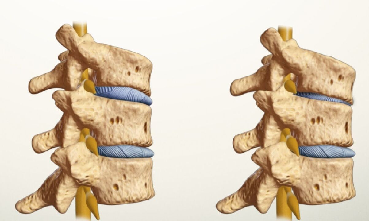 здоровий та хворий хребет при поперековому остеохондрозі