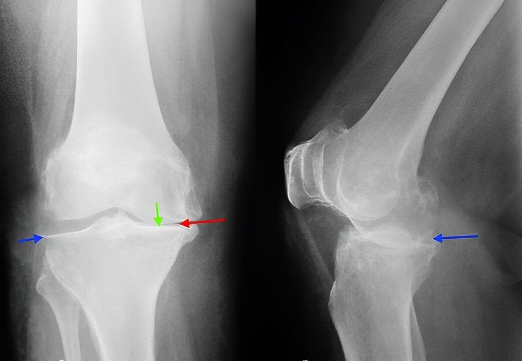 рентген артрозу колінного суглоба