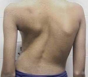 сколіоз як причина болю в спині