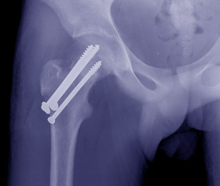 Рентгенографія ТБС, остеосинтез перелому пристроями внутрішньої фіксації