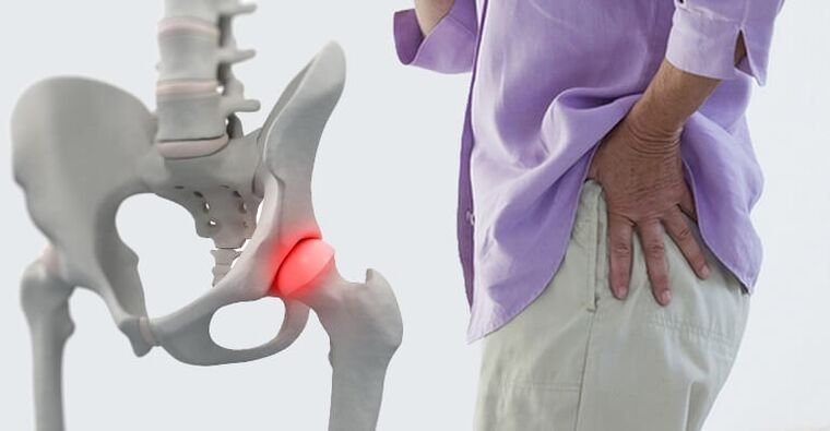 біль в області стегна симптом артрозу тазостегнового суглоба
