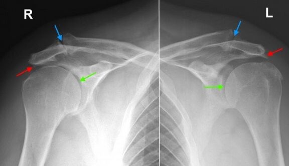 рентгенографія плечових суглобів